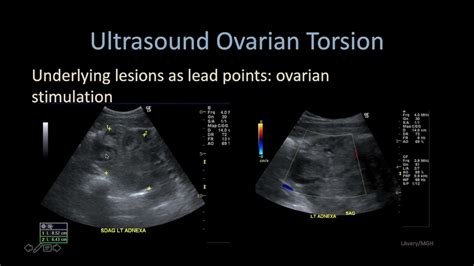 ovarian torsion blood tests|ovarian torsion vs appendicitis.